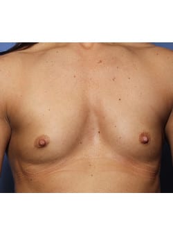 Before Image: Breast Augmentation - front