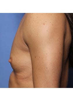 Breast Augmentation