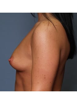 Breast Augmentation