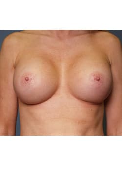 After Image: Breast Augmentation - front