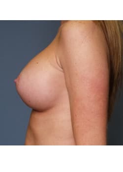 After Image: Breast Augmentation - other