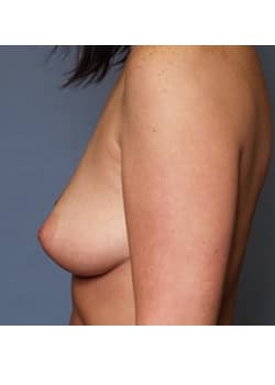 Breast Augmentation