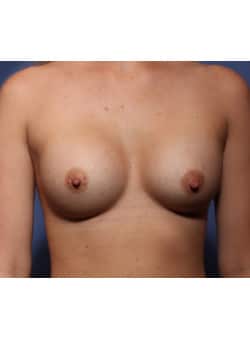 After Image: Breast Augmentation - front