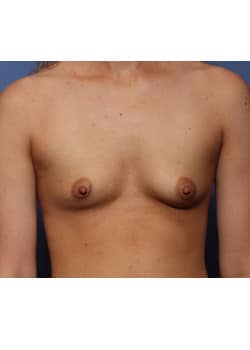 Before Image: Breast Augmentation - front