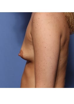 Before Image: Breast Augmentation - other