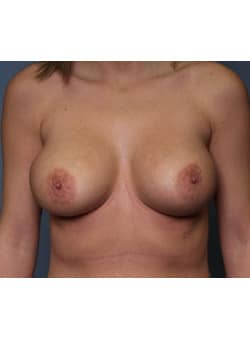 After Image: Breast Augmentation - front