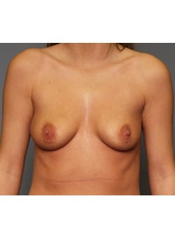 Before Image: Breast Augmentation - front