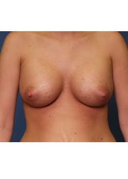 After Image: Breast Augmentation - front
