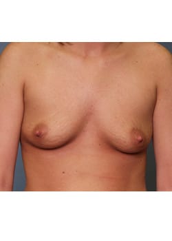 Before Image: Breast Augmentation - front