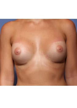 After Image: Breast Augmentation - front