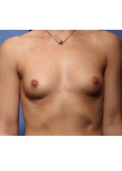 Before Image: Breast Augmentation - front