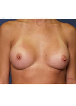 After Image: Breast Augmentation - front