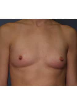 Before Image: Breast Augmentation - front
