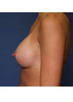 Breast Augmentation