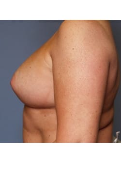 Breast Augmentation