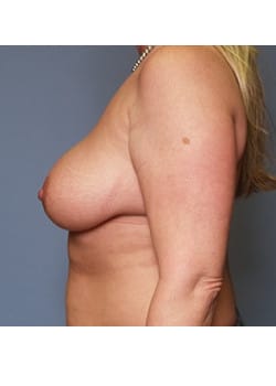 Before Image: Breast Augmentation - other