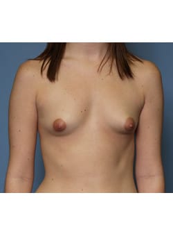 Before Image: Breast Augmentation - front