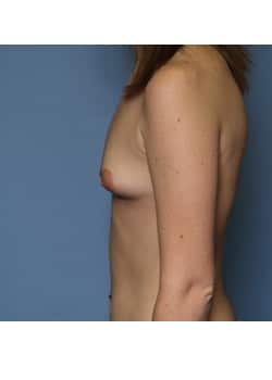 Before Image: Breast Augmentation - other