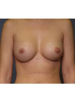 After Image: Breast Augmentation - front