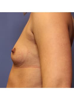 Breast Augmentation