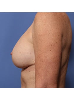 Breast Augmentation