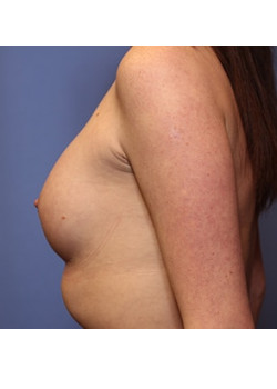 Breast Augmentation Case 57