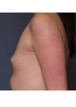 Breast Augmentation Case 57