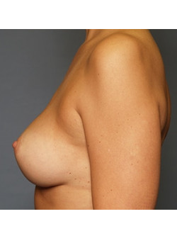 Breast Augmentation Case 58