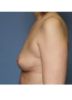 Before Image: Breast Augmentation Case 58 - other