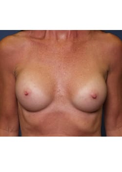 After Image: Breast Augmentation Case 59 - front