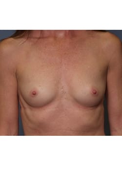 Before Image: Breast Augmentation Case 59 - front