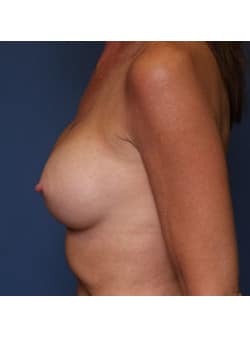 Breast Augmentation Case 59