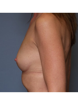 Breast Augmentation Case 59