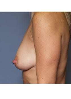 Before Image: Breast Augmentation Case 60 - other