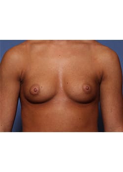 Before Image: Breast Augmentation - front