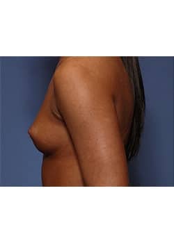 Breast Augmentation