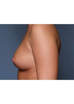 Breast Augmentation
