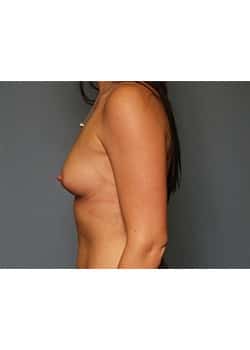 Breast Augmentation