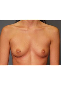 Before Image: Breast Augmentation - front