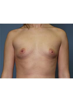 Before Image: Breast Augmentation - front
