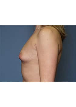 Before Image: Breast Augmentation - other