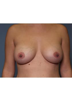 After Image: Breast Augmentation - front