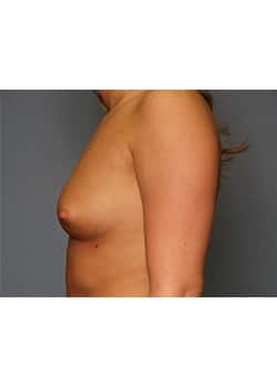 Breast Augmentation