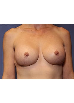 After Image: Breast Augmentation - front