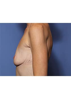 Breast Augmentation