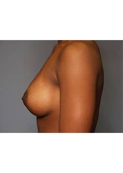 Breast Augmentation