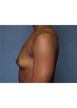 Breast Augmentation