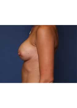 Breast Augmentation