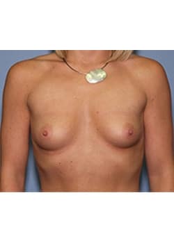 Before Image: Breast Augmentation - front