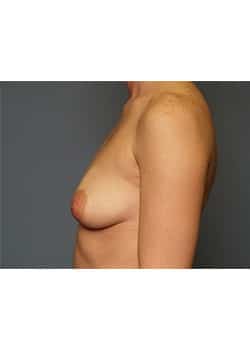 Breast Augmentation